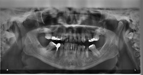 Others recommend that they get baby teeth xray as often as convincing, which would be dictated by your pediatric dentist. Is it Safe To Have Dental X-ray While Pregnant - Connecticut