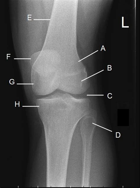 Knee Ap Oblique Projection Medial Internal Rotation Diagram Quizlet