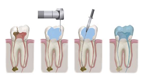 Root Canal Treatment In Istanbul Medic Istanbul