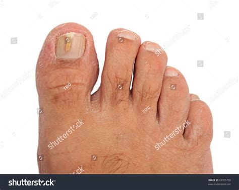 Toenail Infected Fungus Image Isolated On Stock Photo Edit Now 93705778