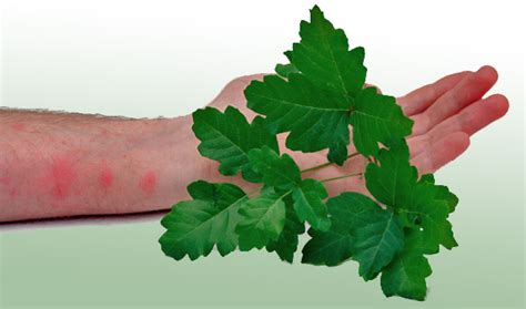 How To Heal Poison Ivy Poison Oak Easy Health