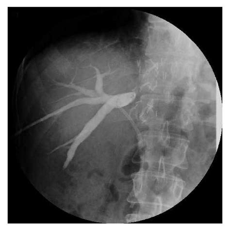Intraoperative Cholangiogram Showing The Complete Filling With Glue Of