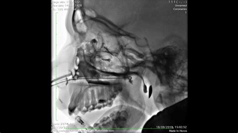 Video X Ray Paranasal Sinuses Yamik Procedure Youtube