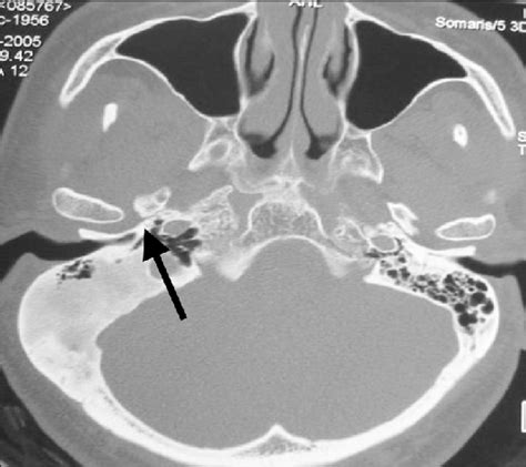 Axial Ct Demonstrating Bony Overgrowth Involving The Right Temporal