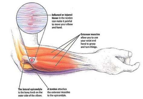 A dislocated shoulder usually happens after a heavy fall onto the arm. How long does Tennis Elbow take to heal? - Quora