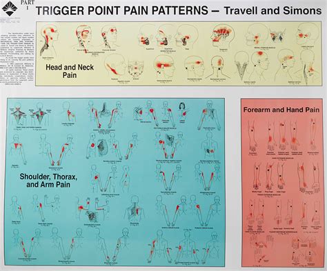 Myofascial Pain Syndrome Causes Symptoms Diagnosis Treatment And Prognosis