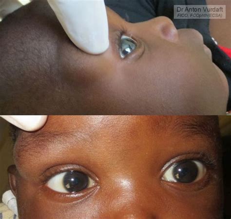Yet Another Periorbital Dermoid Cyst Tropical Ophthalmology