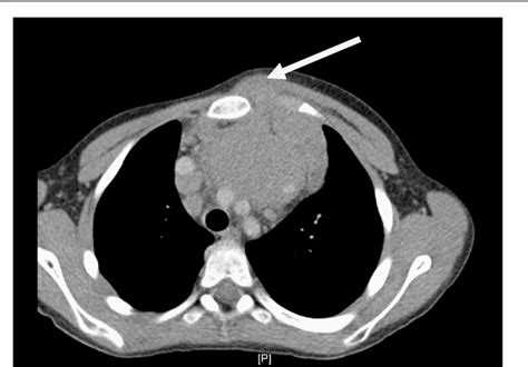 Figure 1 From Hodgkin Lymphoma Presenting With Chest Wall Involvement