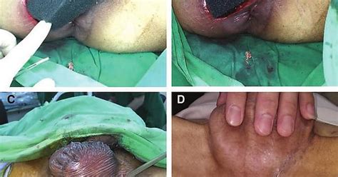 Treatment Of Fournier S Gangrene Scrotum Imgur