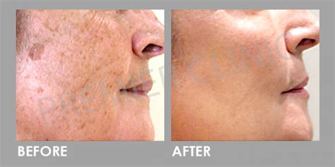Ndyag Laser Pigmentation Removal Skin Whitening