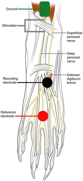 Superficial Peroneal Nerve Sensory Distribution