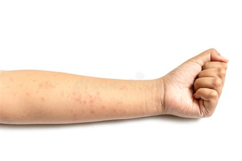 People Getting Red Rash On The Arm Skin Isolated On White Skin Care