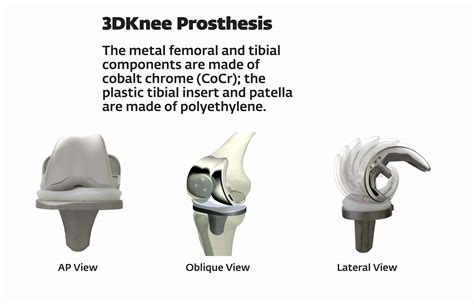 Total Knee Replacement Implants Prostheses Artificial Prosthesis