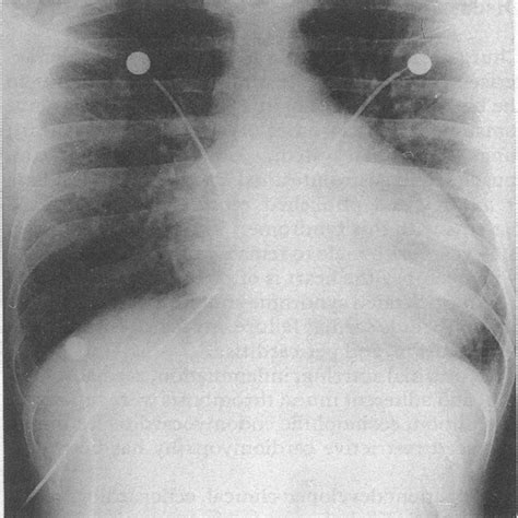 Figure Chest X Ray Showing Considerable Cardiomegaly And Pulmonary