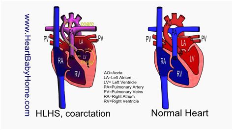60 Hypoplastic Left Heart Syndrome Coarc Youtube