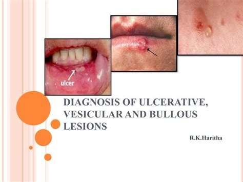 Diagnosis Of Ulcerative Vesicular And Bullous Lesion Ppt