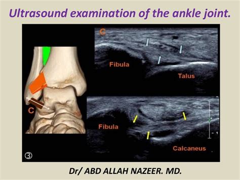Presentation1pptx Ultrasound Examination Of The Ankle Joint