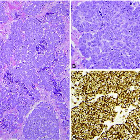 Histopathology Of The Fifth Merkel Cell Carcinoma A Very Dense Sheets