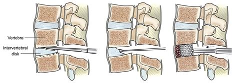 Spinal Fusion Minimally Invasive Tlif And Plif Dr Prem Pillay