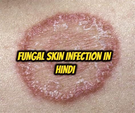 Fungal Skin Infection In Hindi फंगल स्किन इंफेक्शन