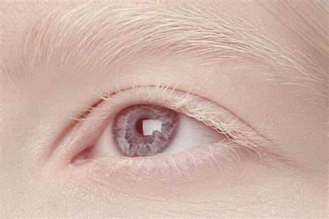 Does Albinism Cause Vision Problems Eye Science The Eye News