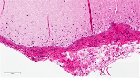 Mucous Retention Cyst Lip Pathology Outlines