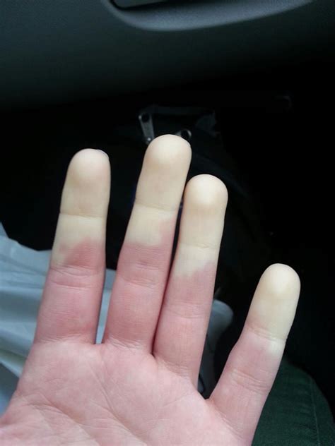 This Is What Raynauds Syndrome Looks Like On Me Rwtf