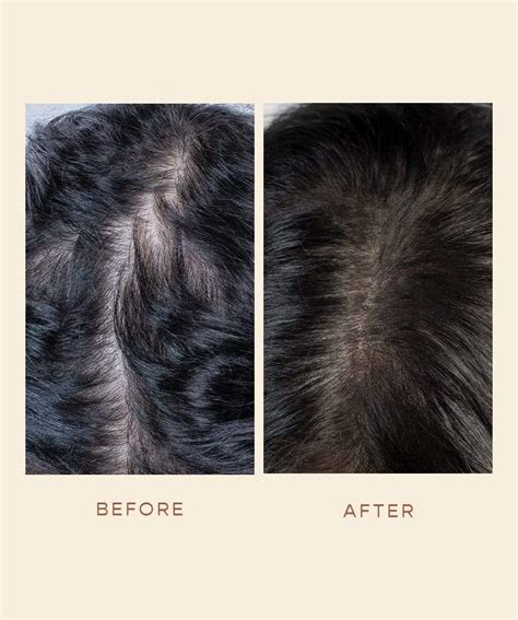 Iron Deficiency Hair Texture Ubicaciondepersonascdmxgobmx