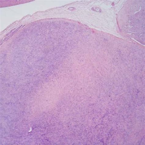 Palmar Fibromatosis Multinodular Poorly Demarcated Lesion With