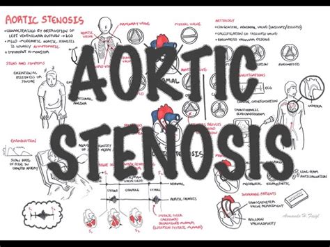 Aortic Stenosis Overview Signs And Symptoms Pathophysiology Treatment Medical Discover