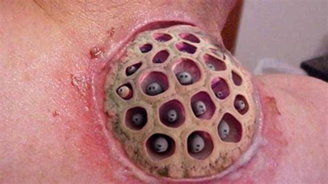 Lotus Pod Holes In Skin