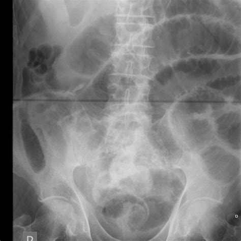 Abdominal X Ray Of Patient 2 Showing Evidence Of Small Bowel
