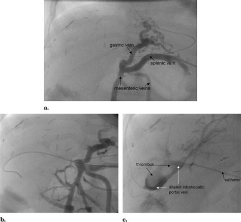 Transsplenic Endovascular Therapy Of Portal Vein Stenosis And