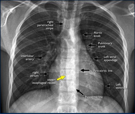 How Is A Chest X Ray Performed Worldofwardcrap