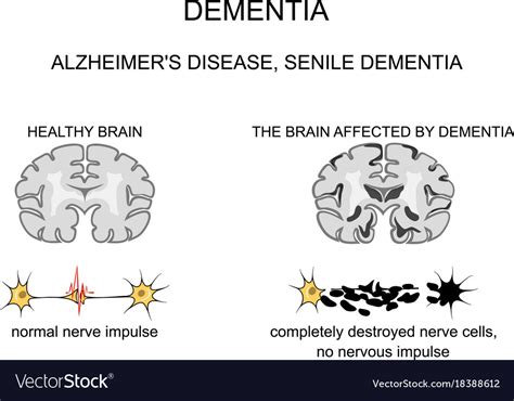 Dementia Alzheimer S Disease Pathogenesis Vector Image