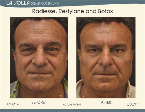 Patient Treated With Radiesse Restylane And Botox At La Jolla Cosmetic