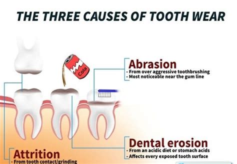 idyll dental 3 common causes of tooth wear