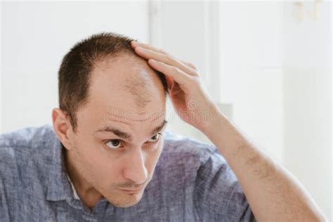 277 Baldness Male Pattern Stock Photos Free And Royalty Free Stock