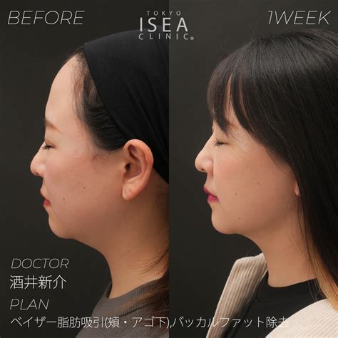 顔の脂肪吸引のデメリットとメリットを比較 ドクターブログ 顔の脂肪吸引なら東京イセアクリニック