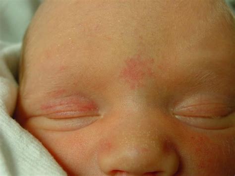 Learning Pediatrics Photos Of Salmon Patches In Neonates