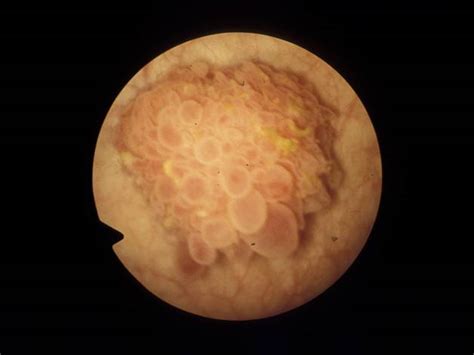 Bladder Cancer - Renal and Urology News