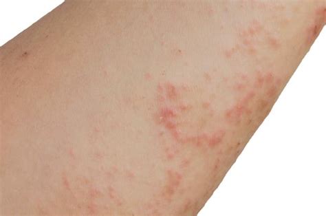 Scabies Nidirect