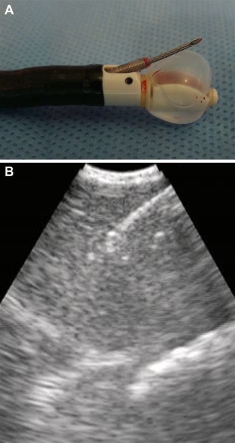 Endobronchial Ultrasound‐guided Transbronchial Needle Aspiration Ebus