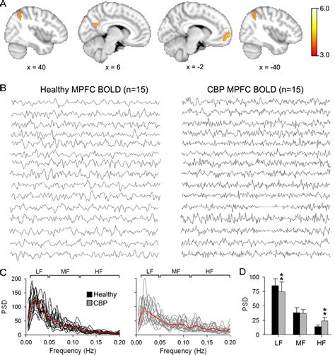 The Cortical Rhythms Of Chronic Back Pain Journal Of Neuroscience