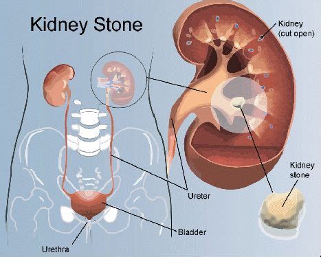 Renal Calculi | Renal Treatment Centers