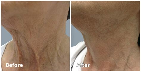 Fractora Austin Laser Resurfacing Skin Tightening The Med Spa