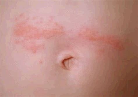 Rash Around Belly Button Causes And Treatments New Health Advisor