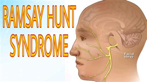 Ramsay Hunt Syndrome Herpes Zoster Oticus Facial Nerve Paralysis
