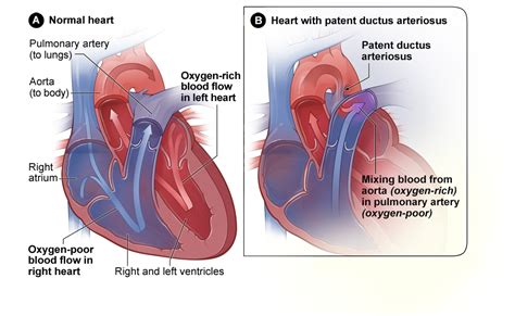 Congenital Heart Defects Diagram