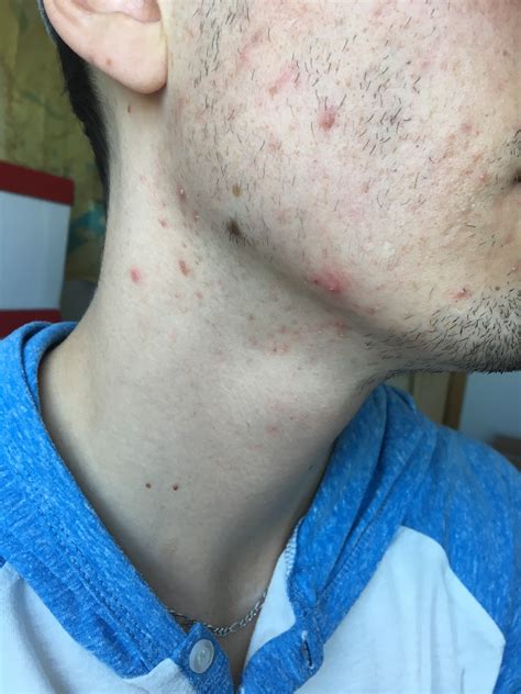 Male Hormonal Acne Help Tried Everything Hormonal Acne